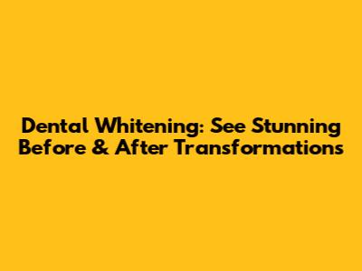 Dental Whitening: See Stunning Before & After Transformations