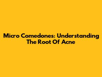 Micro Comedones: Understanding The Root Of Acne